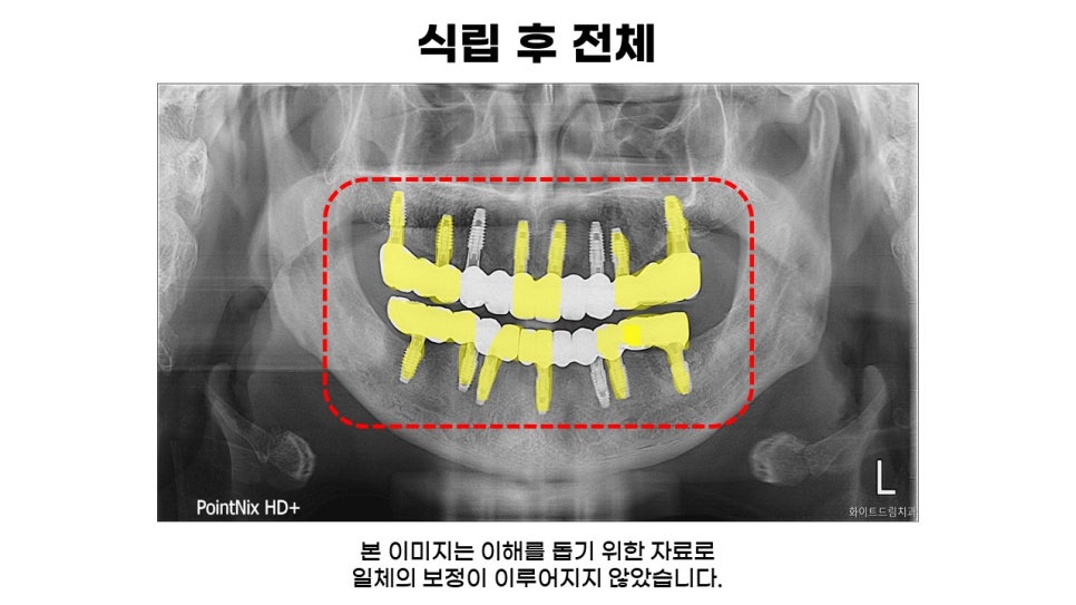 40대임플란트식립후기 및 어금니임플란트 가격, 종류 알아보기 위해 관련 이미지 12