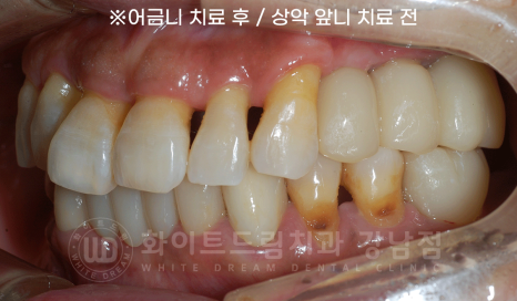 서초동 치과 추천 / "임플란트 개수를 줄이는 식립 방법은?" 강남 화이트드림치과 임플란트 관련 이미지 13