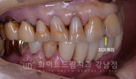 중년 앞니라미네이트 / 노화로 마모되고 누렇게 변한 치아, 어떻게 치료할까? 관련 이미지 7