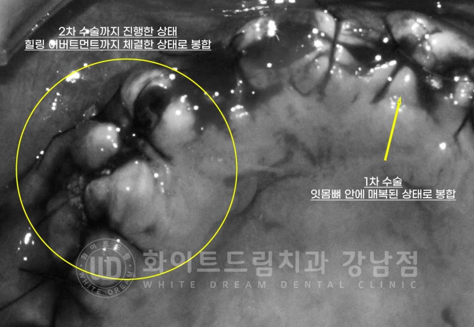 임플란트 1차 수술, 2차 수술이란 무엇일까? (+ 상악 전체 임플란트 치료 기간) 관련 이미지 10