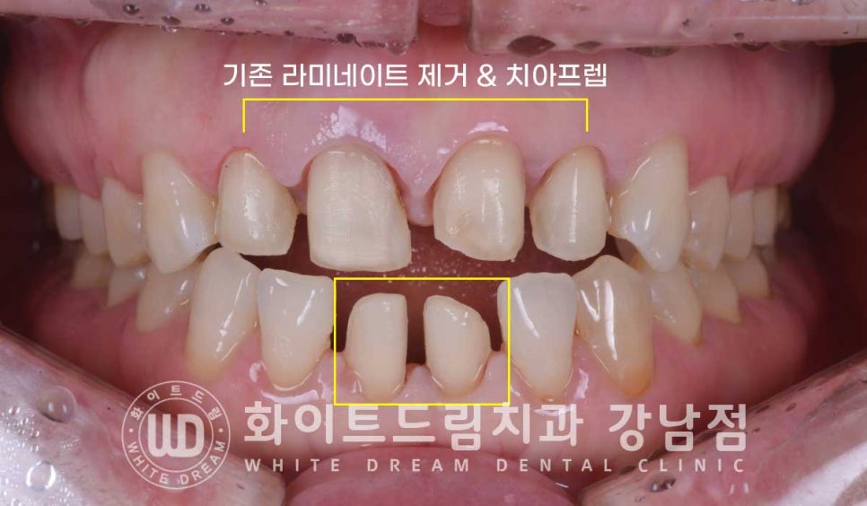 벌어진 앞니 라미네이트 / 50대 시니어 라미네이트 치료 사례 관련 이미지 7