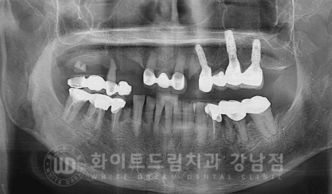 임플란트 1차 수술, 2차 수술이란 무엇일까? (+ 상악 전체 임플란트 치료 기간) 관련 이미지 14