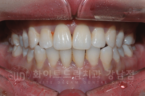 강남역 원데이 라미네이트 "유튜브 촬영하는데 치아가 신경 쓰여요" #강남화이트드림치과 관련 이미지 12