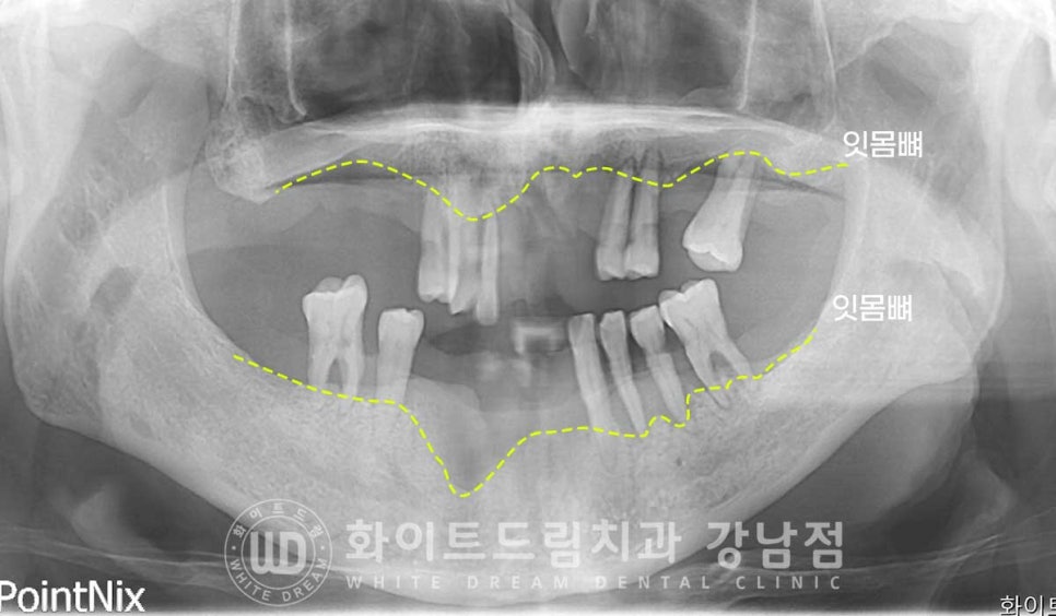 치주염 전체임플란트, 염증으로 인한 상악동 천공 & 신경관 가까이 녹은 잇몸뼈. 임플란트 식립 가능할까? 관련 이미지 8