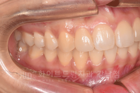 신논현역 라미네이트 / 과개교합 치아교정 + 왜소치 라미네이트 진행 case 관련 이미지 14
