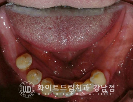 상악 풀케이스임플란트 사례 / "지인 추천으로 인천에서 왔어요." 관련 이미지 5