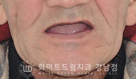 전체 임플란트 치료 기간과 수술 후 나타나는 변화는? 관련 이미지 1