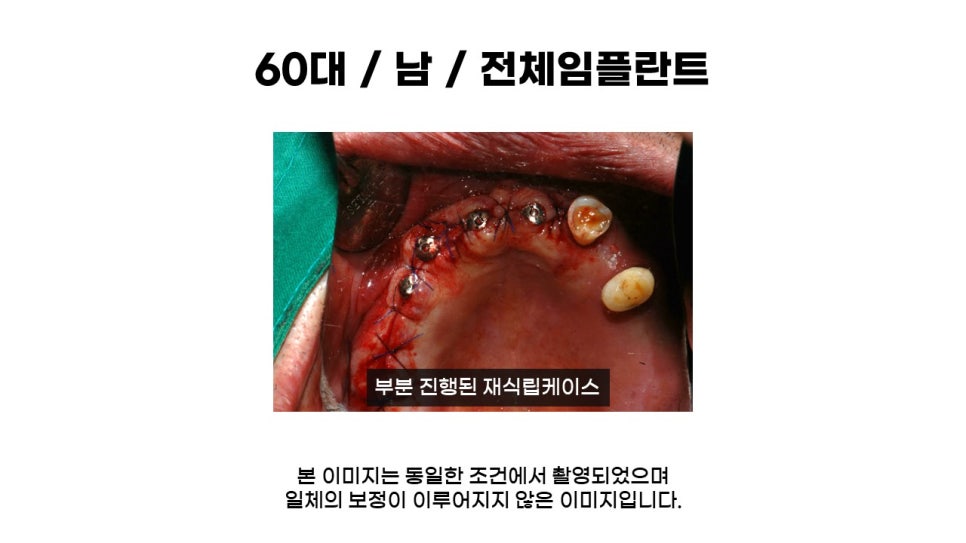 어금니임플란트 수복 및 당뇨환자임플란트 가격, 종류, 통증 관련 이미지 5