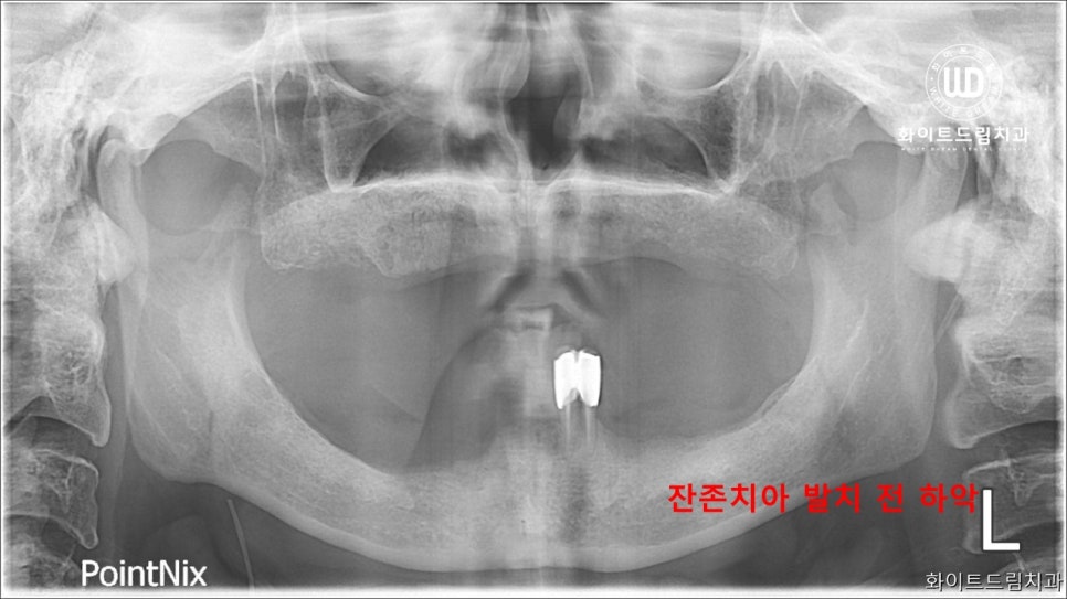 전체 치조골 이식을 동반한 고혈압 환자 임플란트 사례 관련 이미지 3