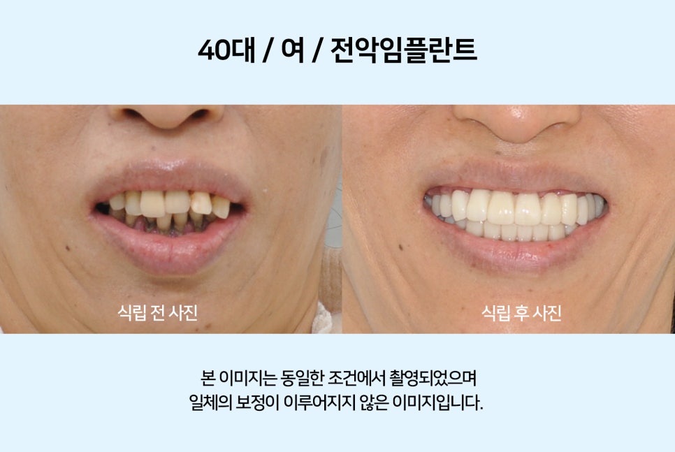 40대 전악 임플란트 식립 증례 관련 이미지 6