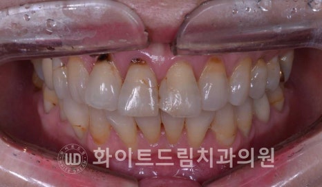 신논현라미네이트, 중년 충치치료, "치경부 우식증, 라미네이트로 당일 치료 OK" 관련 이미지 14