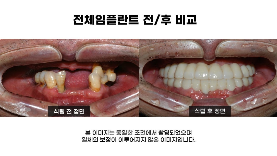 어금니임플란트 수복 및 당뇨환자임플란트 가격, 종류, 통증 관련 이미지 18