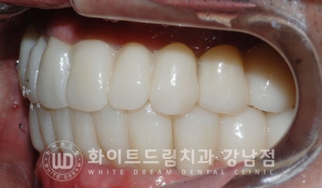 40대 전체임플란트 / 디지털스캔바디를 이용한 전체 임플란트 치료 사례 (Feat. 치주염) 관련 이미지 26