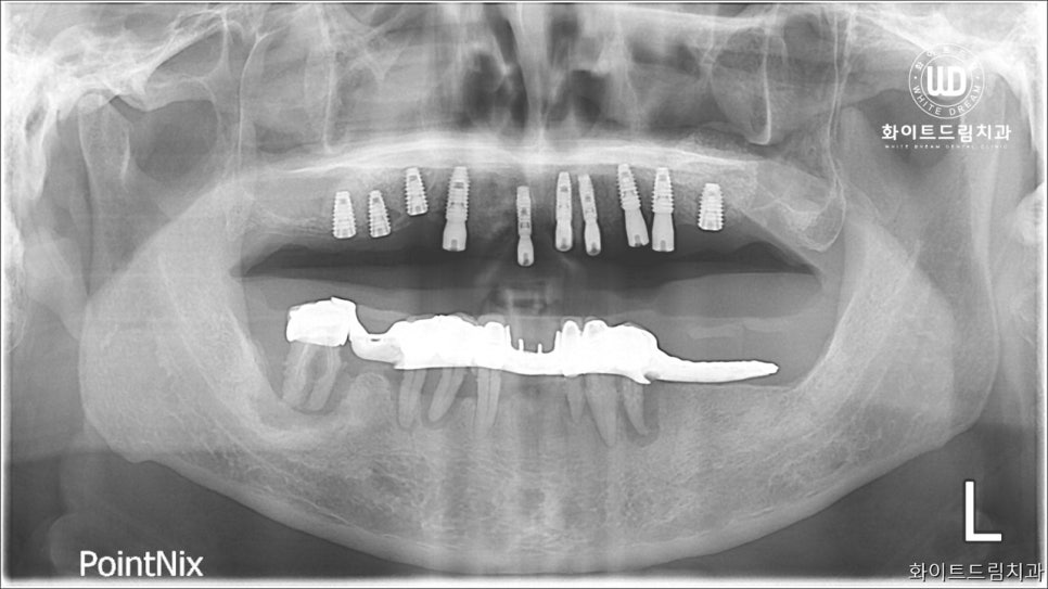 무너진 잇몸뼈와 치아 상실을 대체하는 전악임플란트 치료 사례 관련 이미지 4