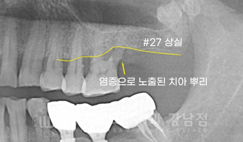 [흔들리는 어금니크라운] 흔들리고 냄새나는 오래된 크라운, 원인은? 관련 이미지 9