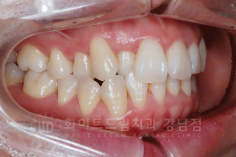 강남 덧니 비발치교정 / 임플란트와 치아교정 동시 진행 case 리뷰. 관련 이미지 22