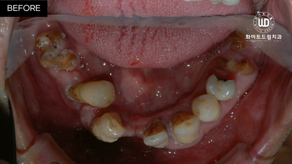 전체임플란트 식립 및 임플란트뼈이식 후기 관련 이미지 2
