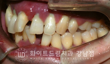 40대 전체임플란트 / 디지털스캔바디를 이용한 전체 임플란트 치료 사례 (Feat. 치주염) 관련 이미지 25