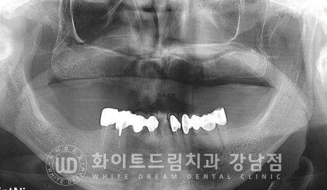 상악 풀케이스임플란트 사례 "부산에서 강남까지 왔어요" 관련 이미지 13