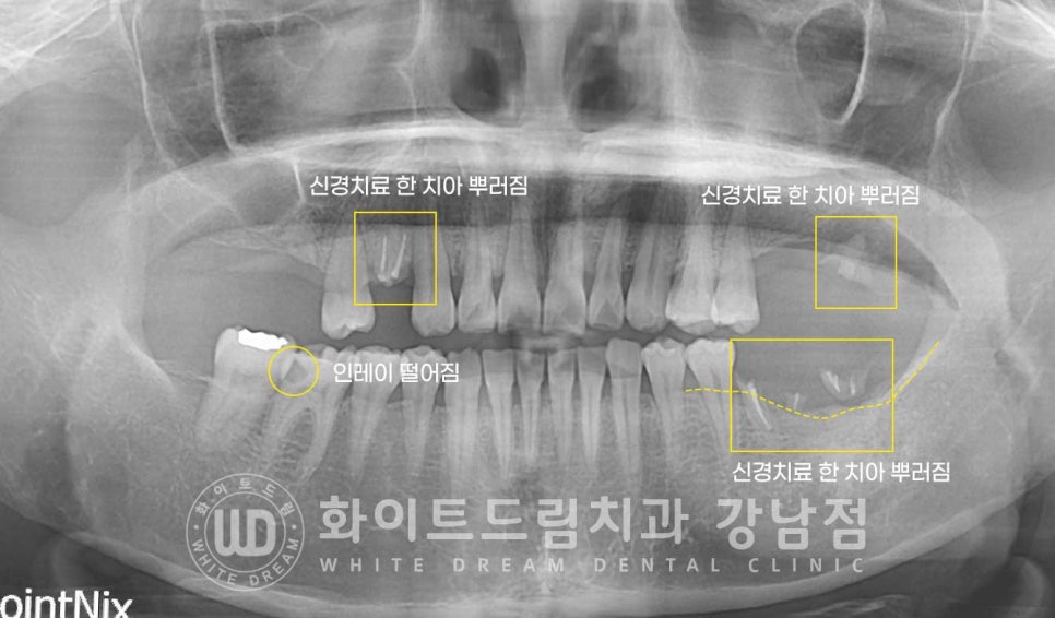 신경치료 후 크라운을 해야 하는 이유 / 크라운을 안 해 부러진 치아 임플란트 치료 case 관련 이미지 8