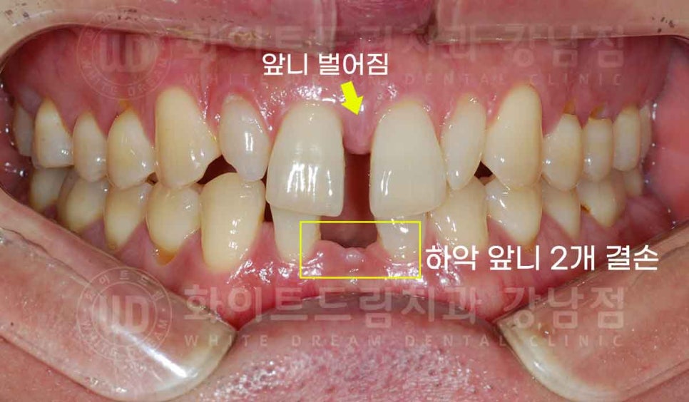 강남역 결손치 "앞니 두 개가 없고, 벌어졌어요" 결손치 치료 방법 관련 이미지 3