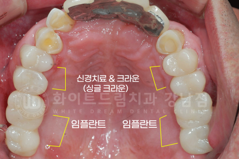 강남역 임플란트치과 / "어금니가 없고 이갈이가 심해요" 강남역 화이트드림치과 관련 이미지 13