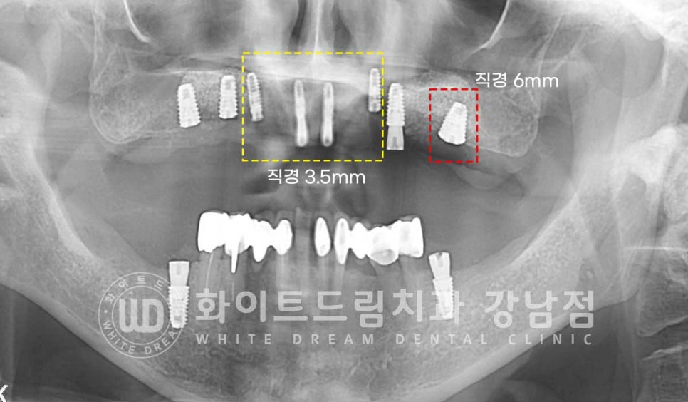 상악 풀케이스임플란트 사례 "부산에서 강남까지 왔어요" 관련 이미지 12