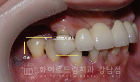 치주염 전체임플란트 치료 사례 / 치아를 흔들리게 만드는 치주염이란? 관련 이미지 11