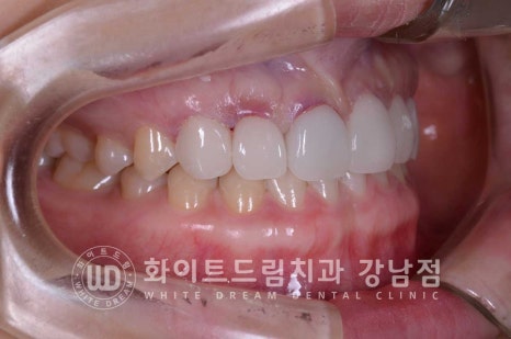 벌어진 앞니라미네이트 / "왜소치로 치아가 벌어졌어요" 치료 사례 관련 이미지 9