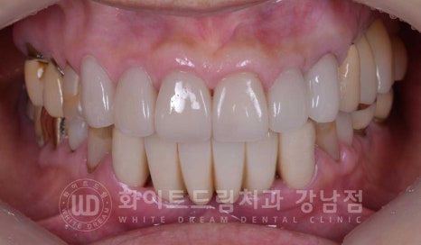 중년 앞니라미네이트 / 노화로 마모되고 누렇게 변한 치아, 어떻게 치료할까? 관련 이미지 4