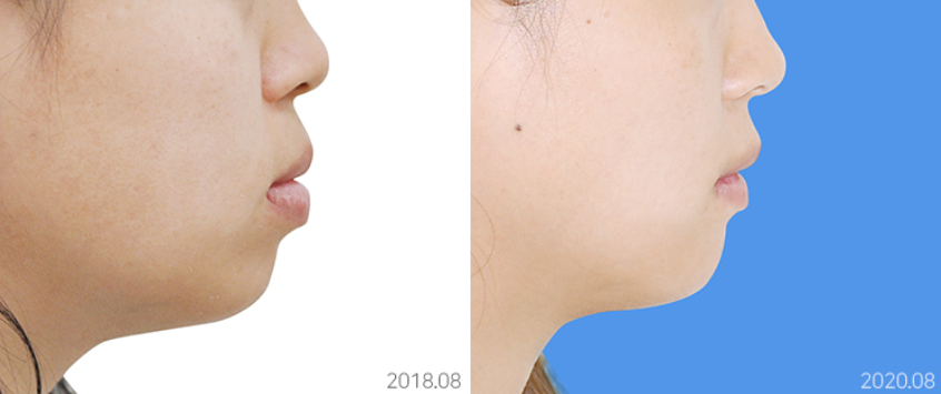 얼굴공개없는 치아교정 모델 모집 관련 이미지 8