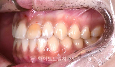 강남역앞니치과 / "신경치료한 치아가 누렇게 변했어요." 신경치료 후 변색된 치아, 어떻게 치료하나요? 관련 이미지 6