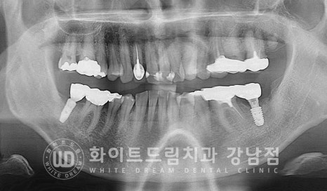 강남역 임플란트재수술 치과 / "임플란트가 흔들려요!" 임플란트 주위염 관련 이미지 12
