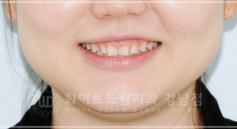 강남역 원데이 라미네이트 "유튜브 촬영하는데 치아가 신경 쓰여요" #강남화이트드림치과 관련 이미지 2