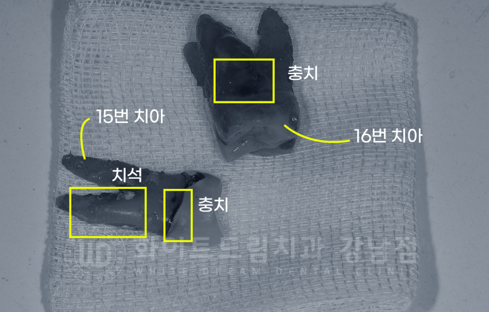 서초동 어금니 임플란트 / 강남역 화이트드림치과 : 상악동 거상술 (crestal approch) 관련 이미지 4