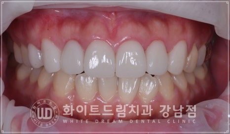 역삼역 왜소치치료 / 치아 하나가 너무 작아요. 왜소치 라미네이트 잘하는 치과 관련 이미지 2