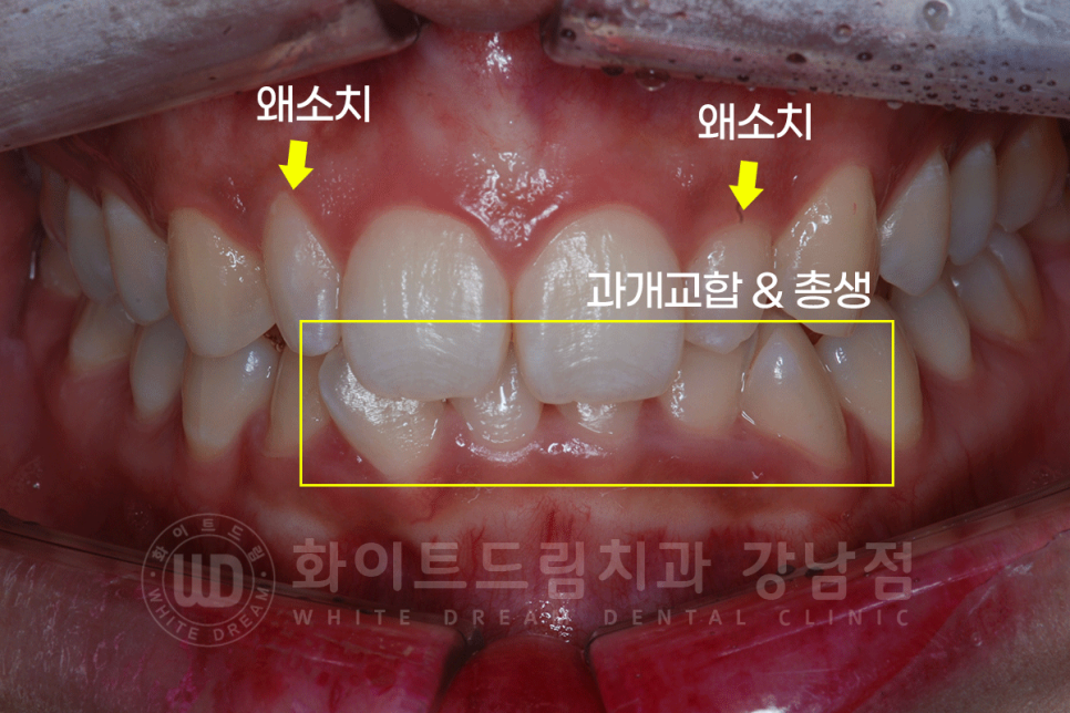 신논현역 라미네이트 / 과개교합 치아교정 + 왜소치 라미네이트 진행 case 관련 이미지 4