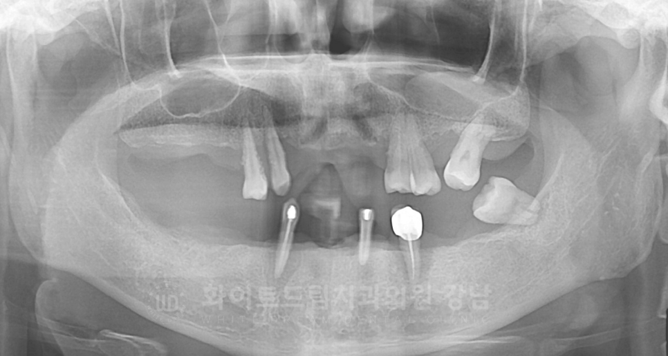 강남역 임플란트 치과 "틀니가 안 맞아서 불편해요" 틀니 → 전체 임플란트로! 관련 이미지 8