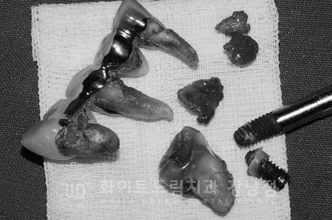 임플란트 재수술의 주원인, "임플란트 주위염과 임플란트 찢어짐!" 관련 이미지 10