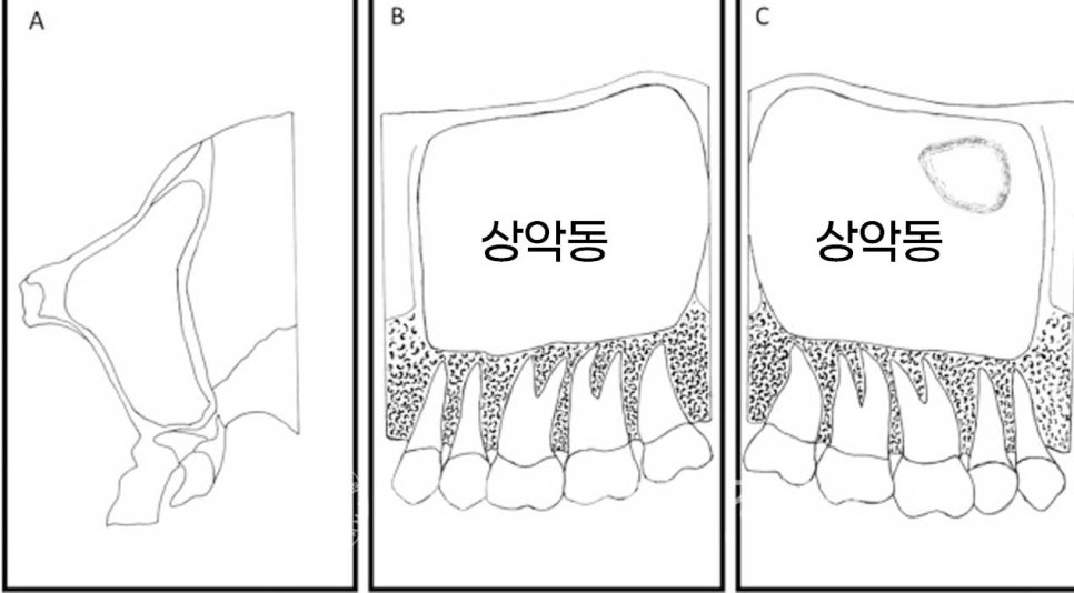 치주염 전체임플란트, 염증으로 인한 상악동 천공 & 신경관 가까이 녹은 잇몸뼈. 임플란트 식립 가능할까? 관련 이미지 9