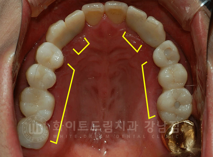 강남역 치과브릿지 "브릿지가 흔들려요" 흔들리는 브릿지 치료는? 관련 이미지 10
