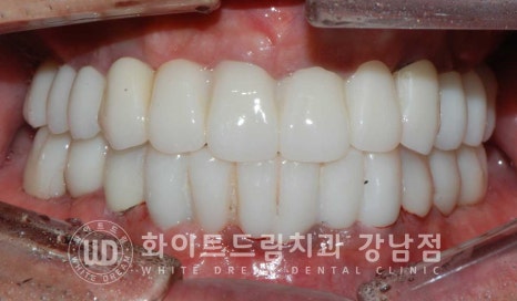 강남역 전악임플란트치과 / 치주 질환이 치아와 임플란트에 끼치는 영향! 관련 이미지 19