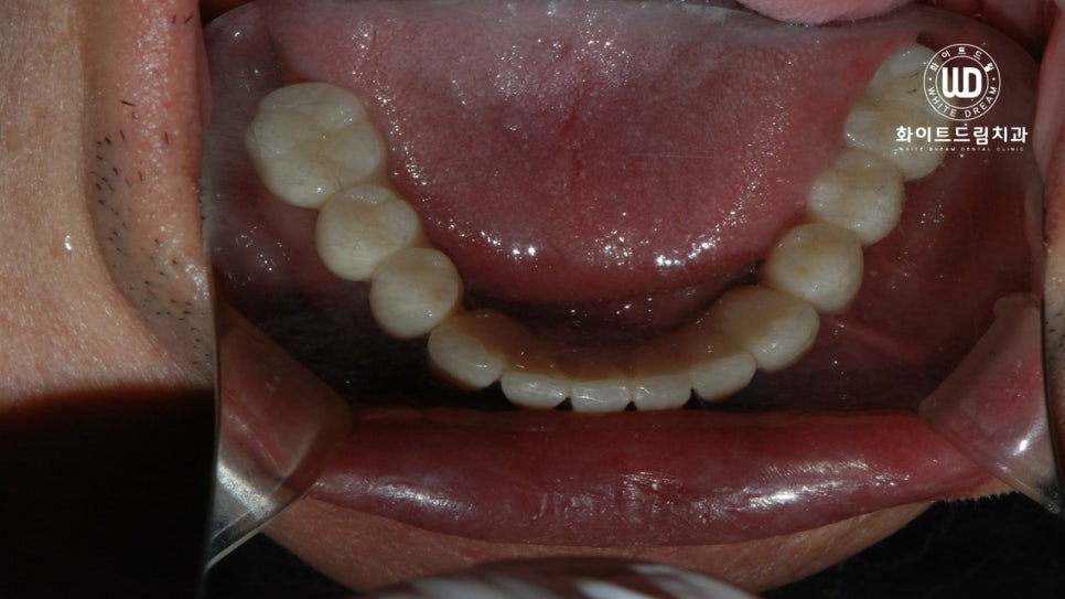 전체 치조골 이식을 동반한 고혈압 환자 임플란트 사례 관련 이미지 10