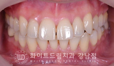 앞니 뻐드러짐 라미네이트 "뻐드러지고 벌어진 앞니" 당일 라미네이트 치료 case 관련 이미지 3