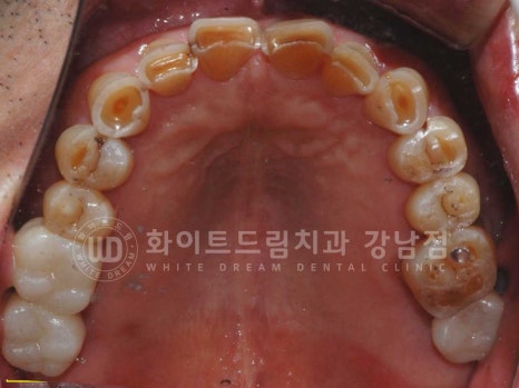 [흔들리는 어금니크라운] 흔들리고 냄새나는 오래된 크라운, 원인은? 관련 이미지 13