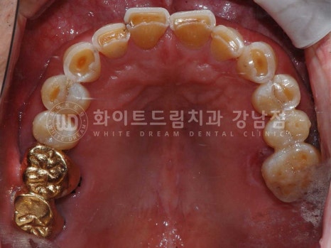 [흔들리는 어금니크라운] 흔들리고 냄새나는 오래된 크라운, 원인은? 관련 이미지 12