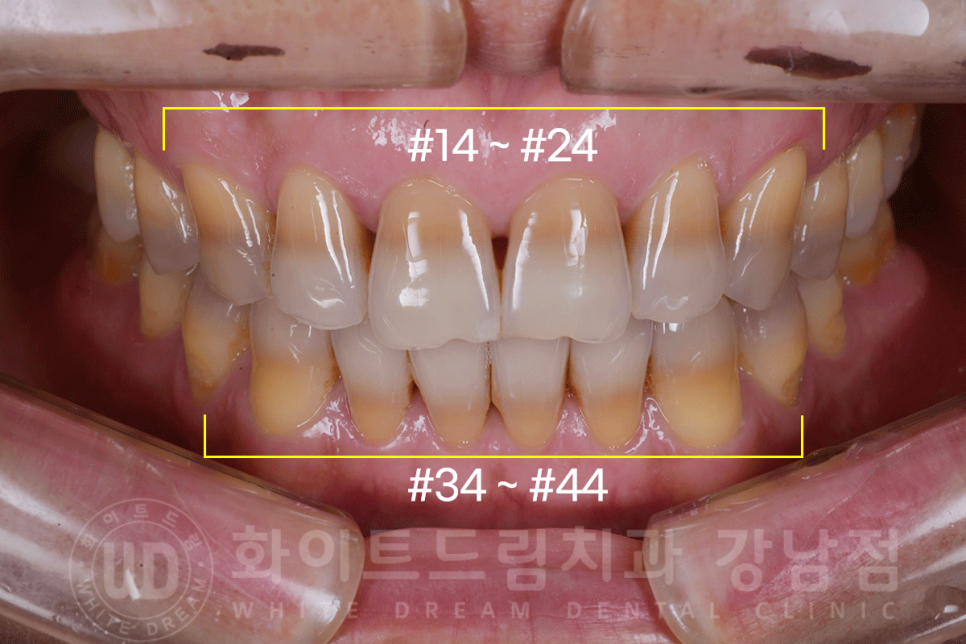 강남역 인근 치과 / 테트라사이클린(tetracycline) 치아 변색 / 라미네이트로 개선! 관련 이미지 7