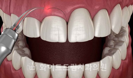 강남역 잇몸성형, 라미네이트와 흔히 동반되는 관련 이미지 5