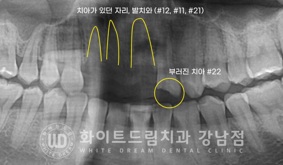 앞니 빠짐 임플란트 / 사고로 인한 앞니 탈구. 앞니 임플란트 치료는? 관련 이미지 3