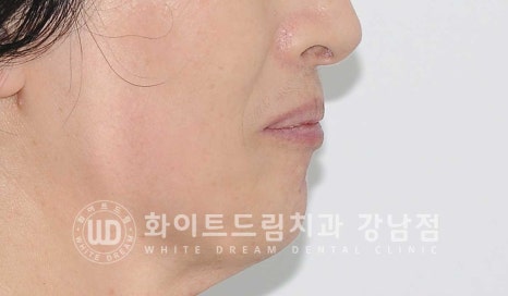 상악 풀케이스임플란트 사례 "부산에서 강남까지 왔어요" 관련 이미지 23